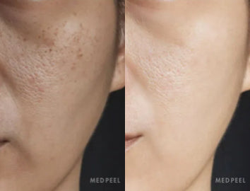 chemical peels and skincare