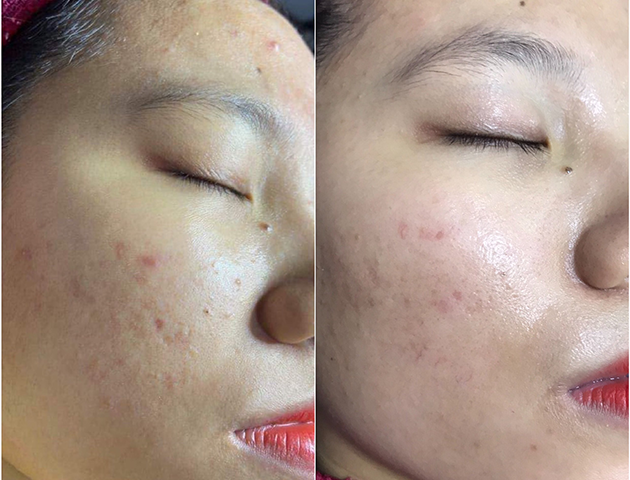 chemical peels and skincare