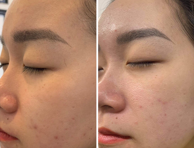 chemical peels and skincare